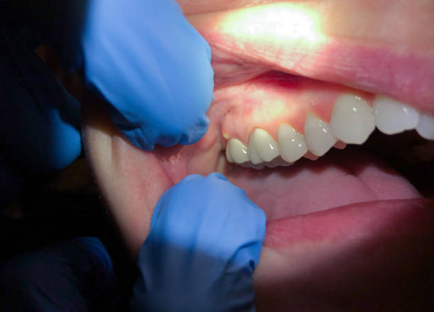 Best Emergency Broken Tooth Repair in Wellman, IA